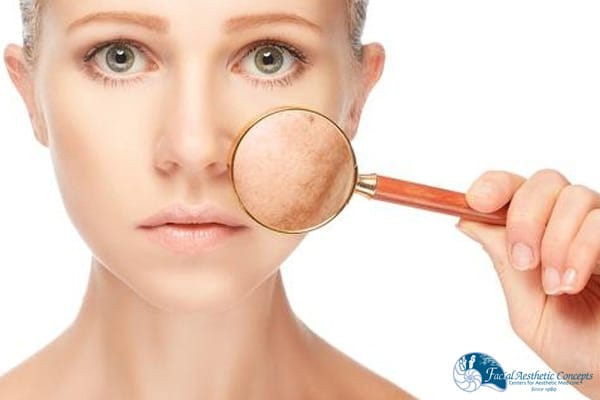 Are chemical peels safe - FAC
