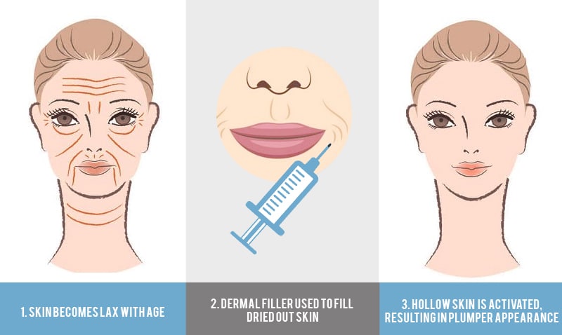 How do dermal fillers work Infographic