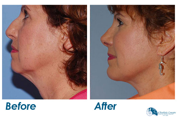 Facelift Before and After Cheeks and Jowels