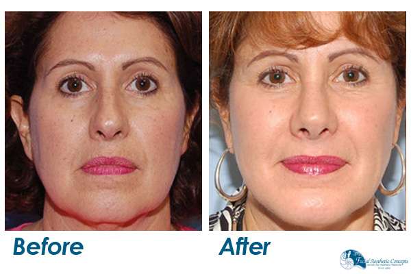 Facelift Before and After Front Face