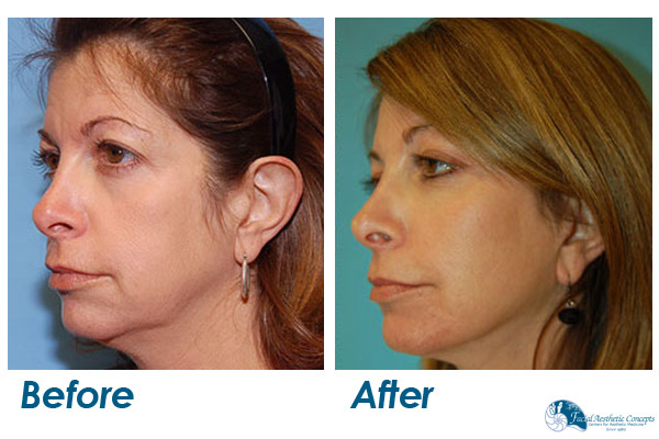 Face Surgery Before And After: The Entire Facelift Surgery Process Explained (With Results) img 4