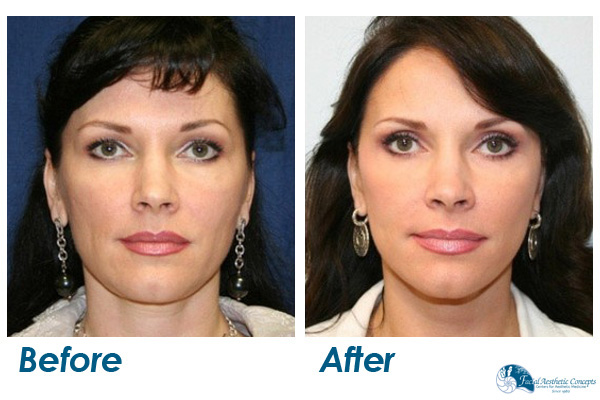 Facelift Surgery Before and After Results