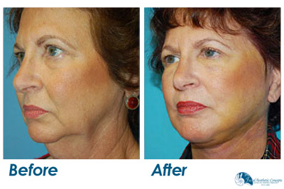Facelift Surgery Before and After Results