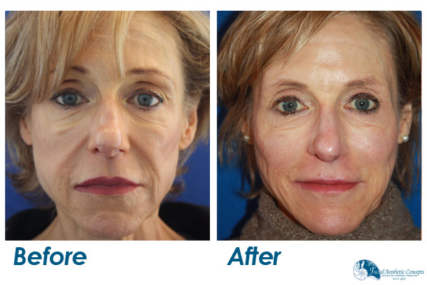 Dermal Filler Before and After Nasal Fold and Wrinkles