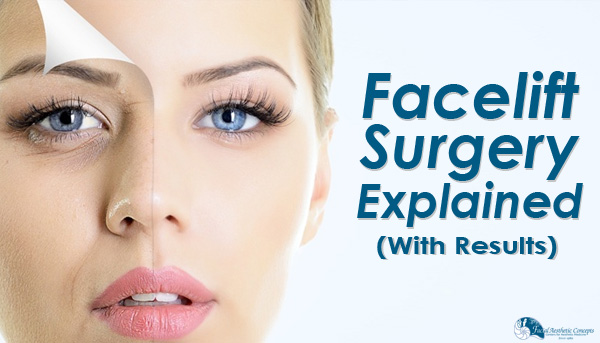 Facelift Surgery Before and After Process Explained 