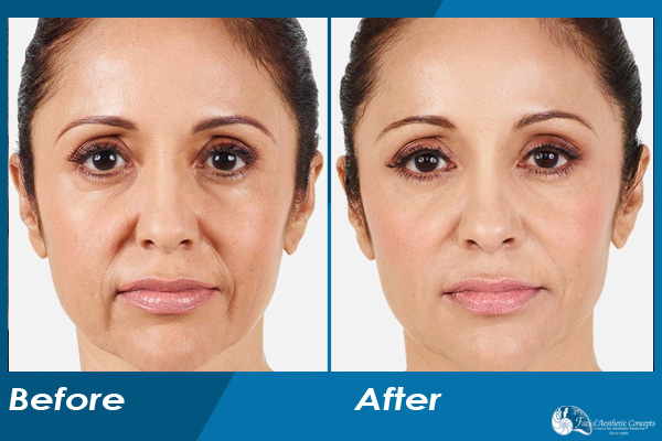 Dermal Fillers Before and After 1