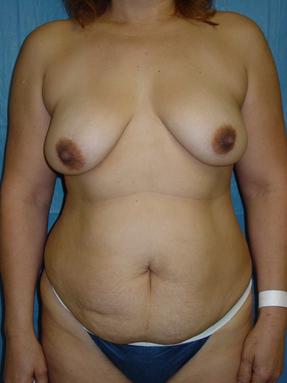 Tummy Tuck Patient Photo - Case 3398 - before view-0