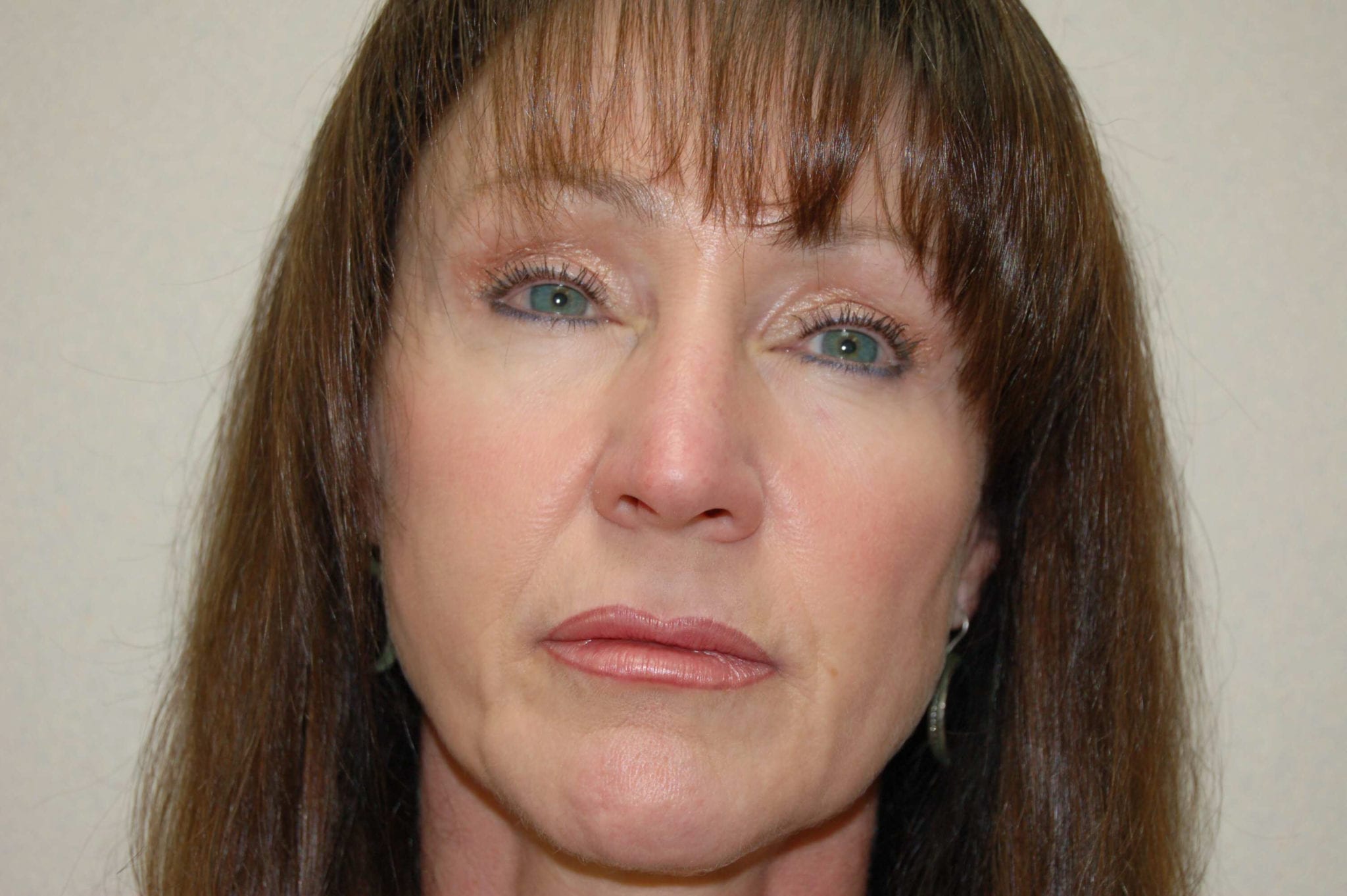 Facial Rejuvenation Patient Photo - Case 3805 - before view-0