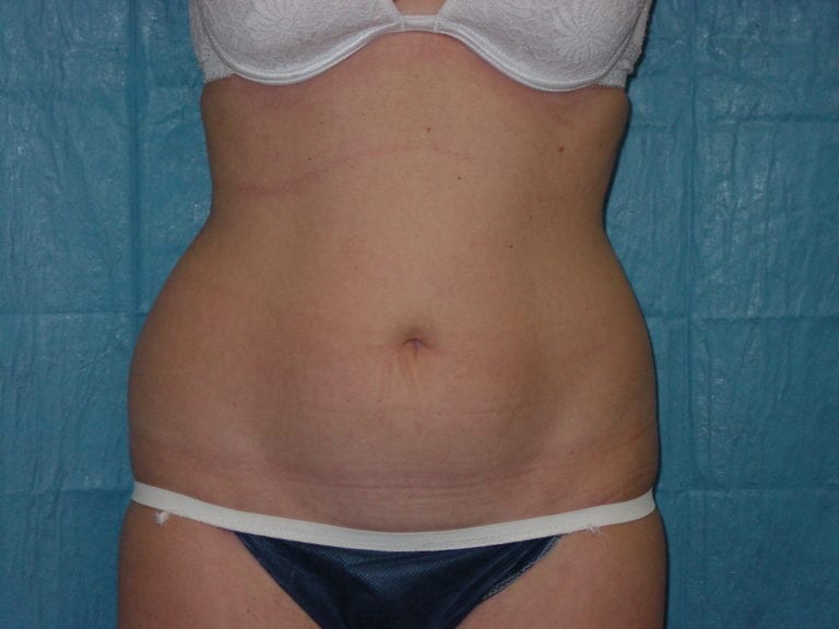 Liposuction - Case 3277 - Before