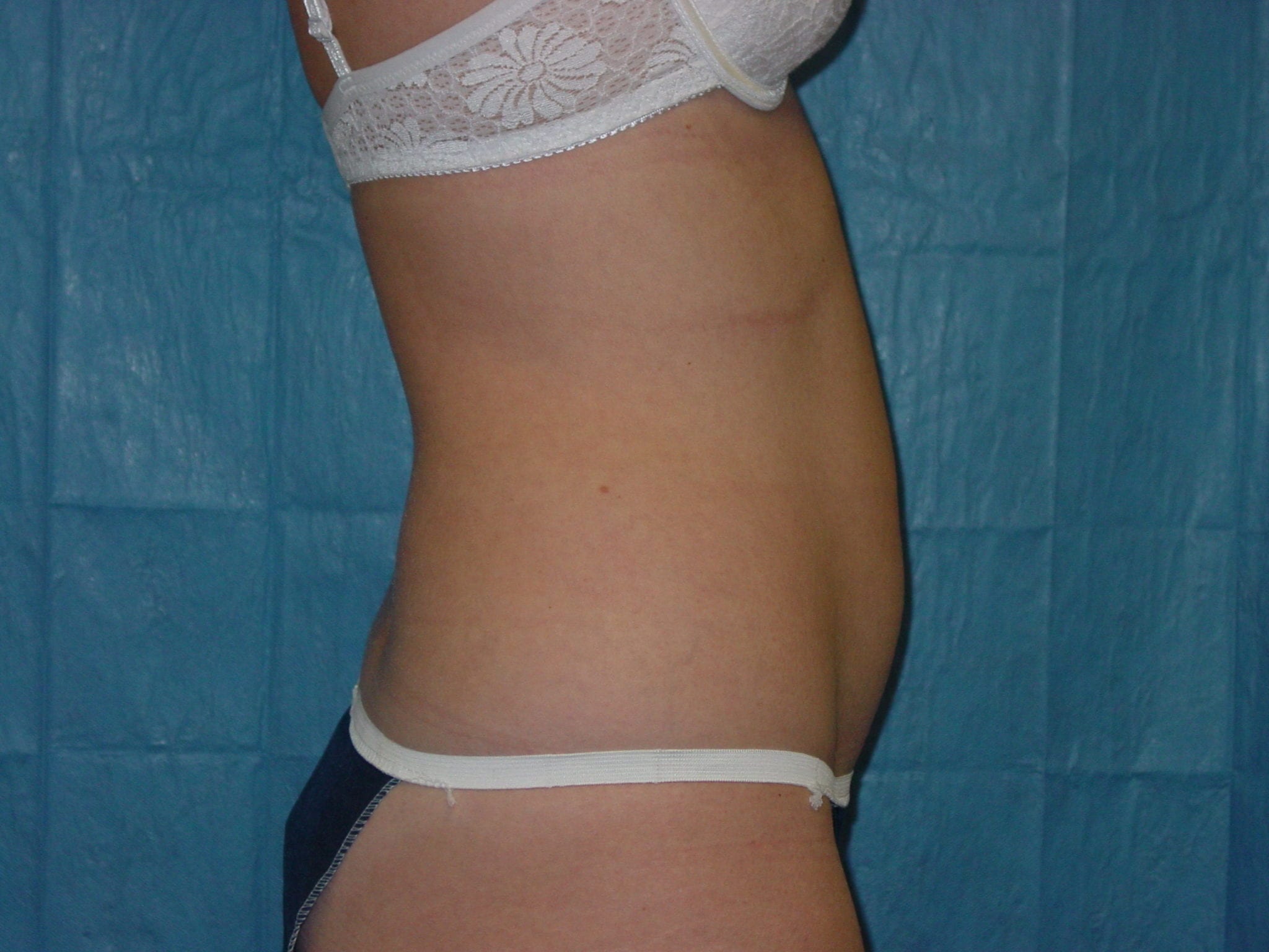 Liposuction Patient Photo - Case 3277 - before view-3