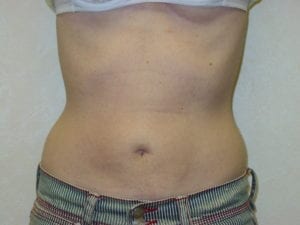 Liposuction in Aliso Viejo Orange County, Ca - After 2b