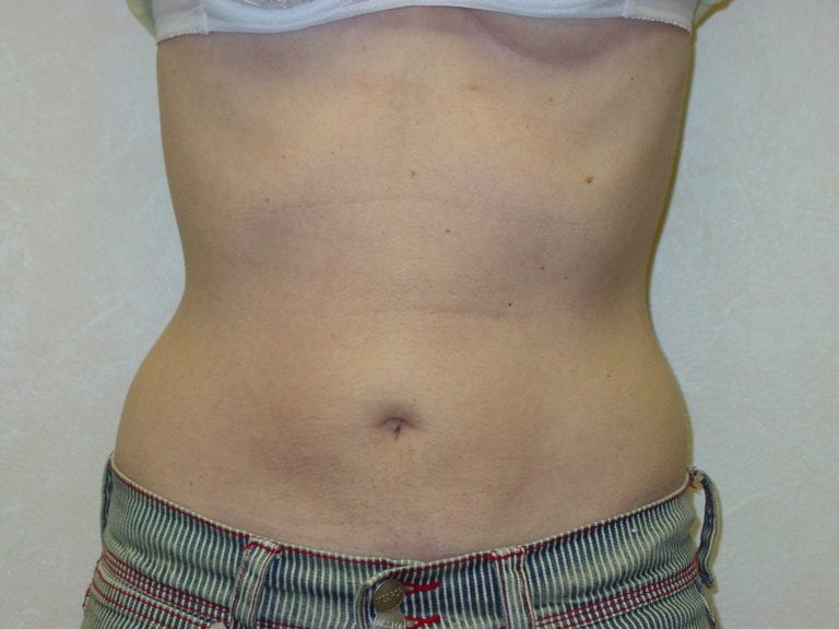 Liposuction - Case 3277 - After