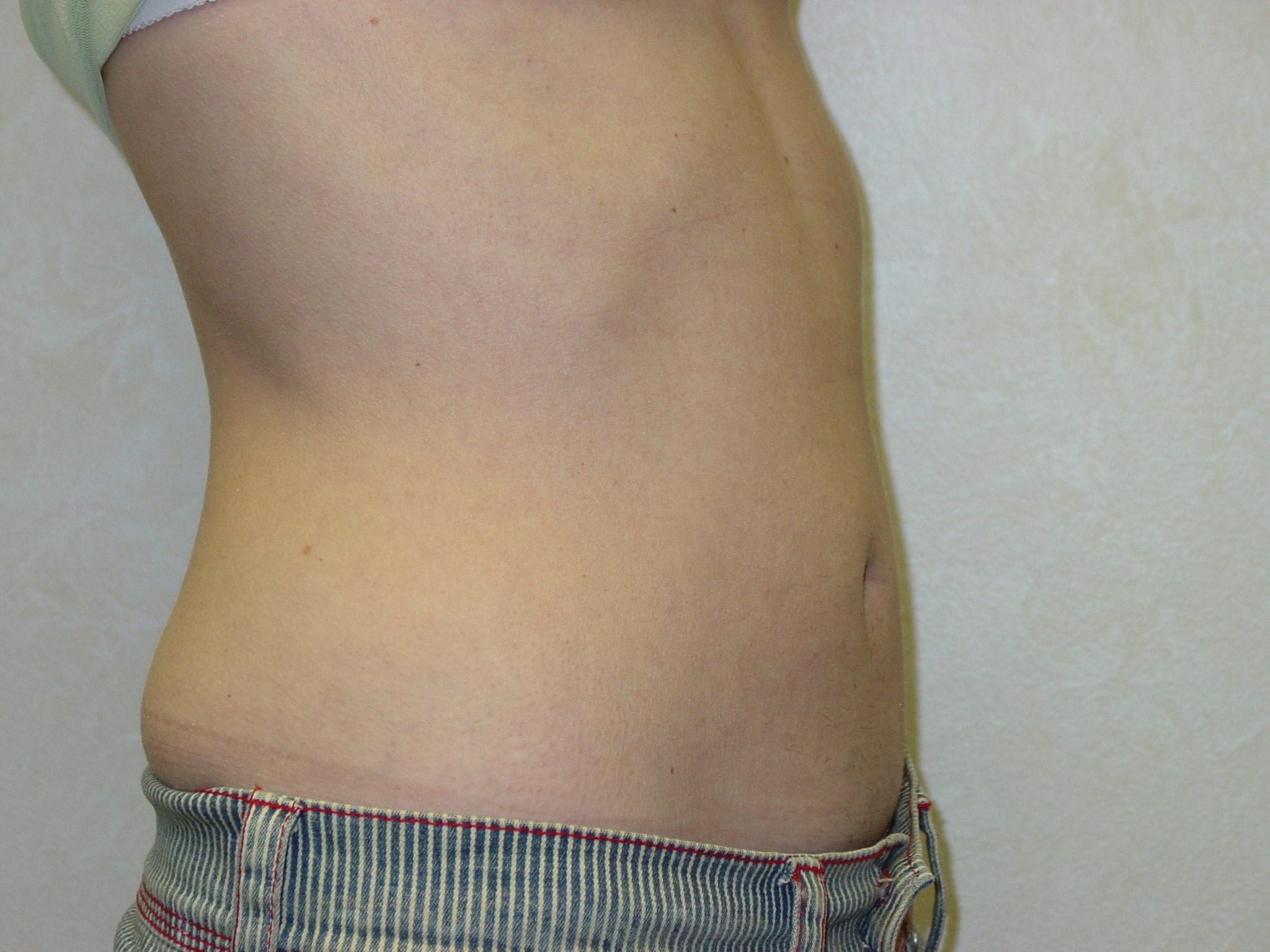 Liposuction Patient Photo - Case 3277 - after view-4