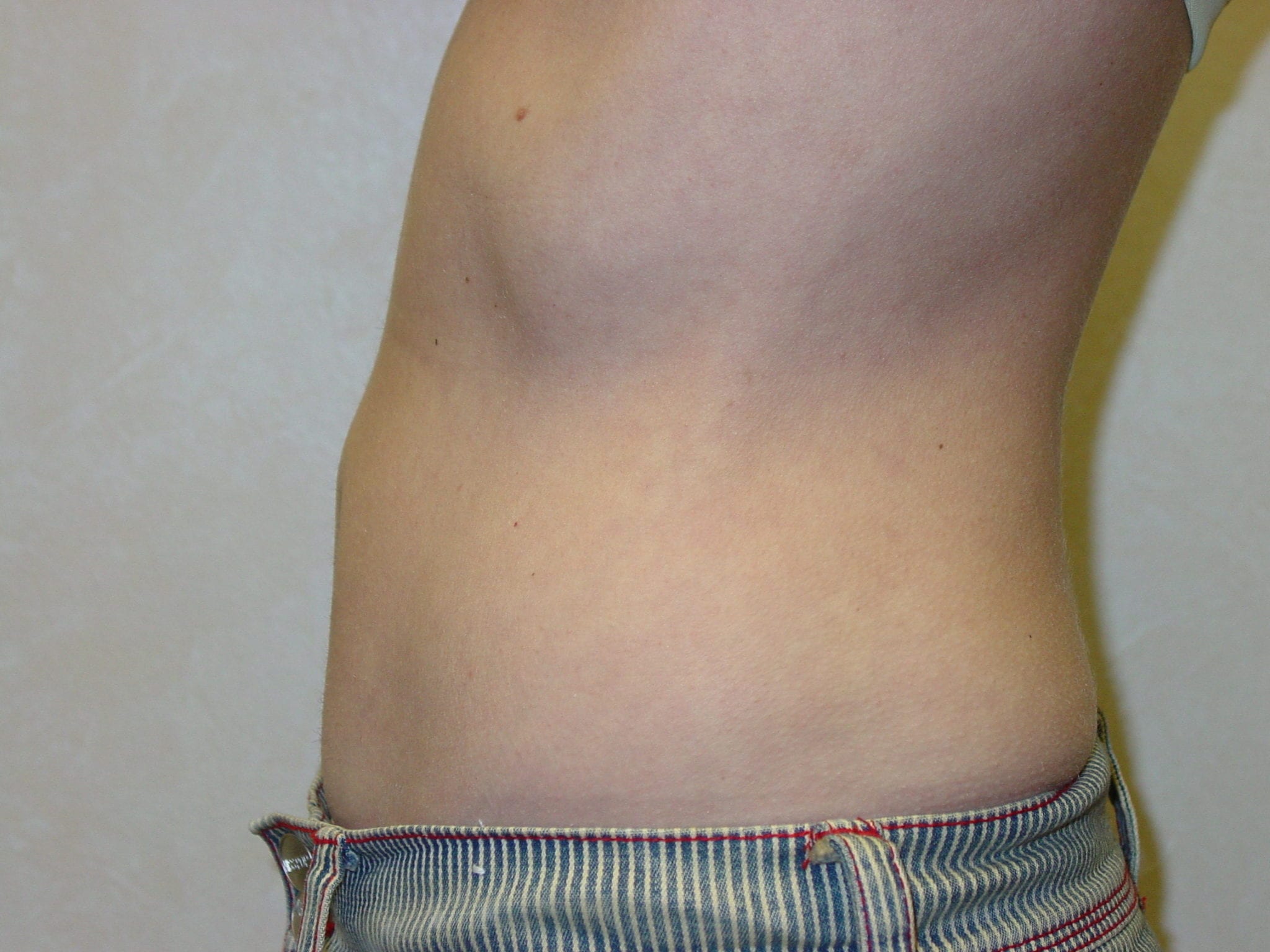 Liposuction Patient Photo - Case 3277 - after view-1