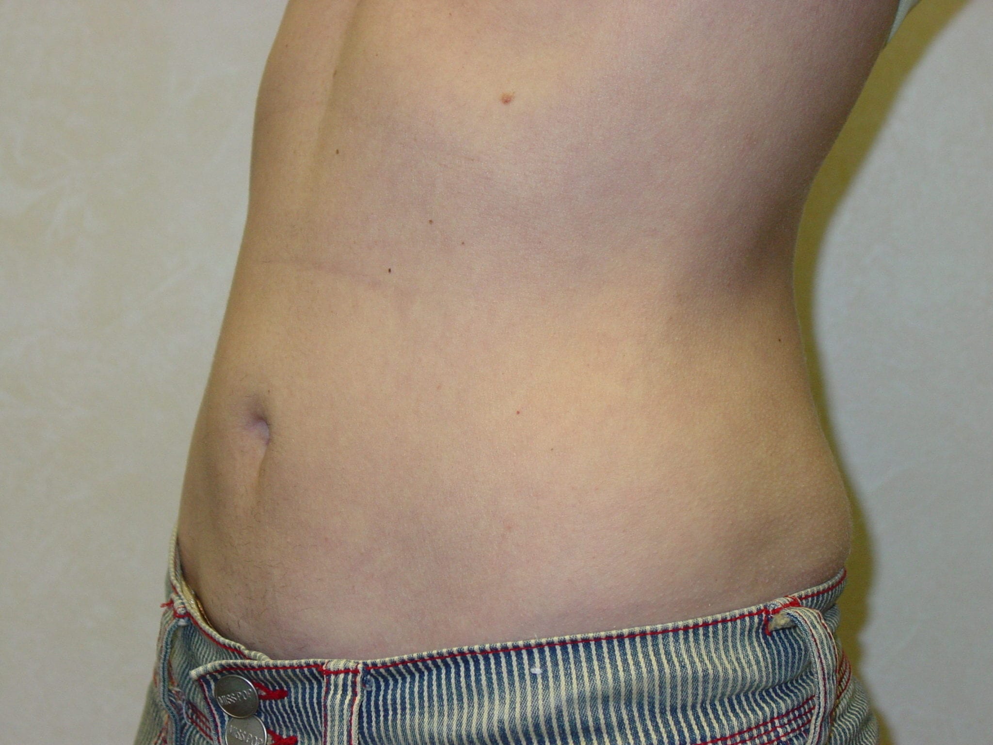 Liposuction Patient Photo - Case 3277 - after view-2