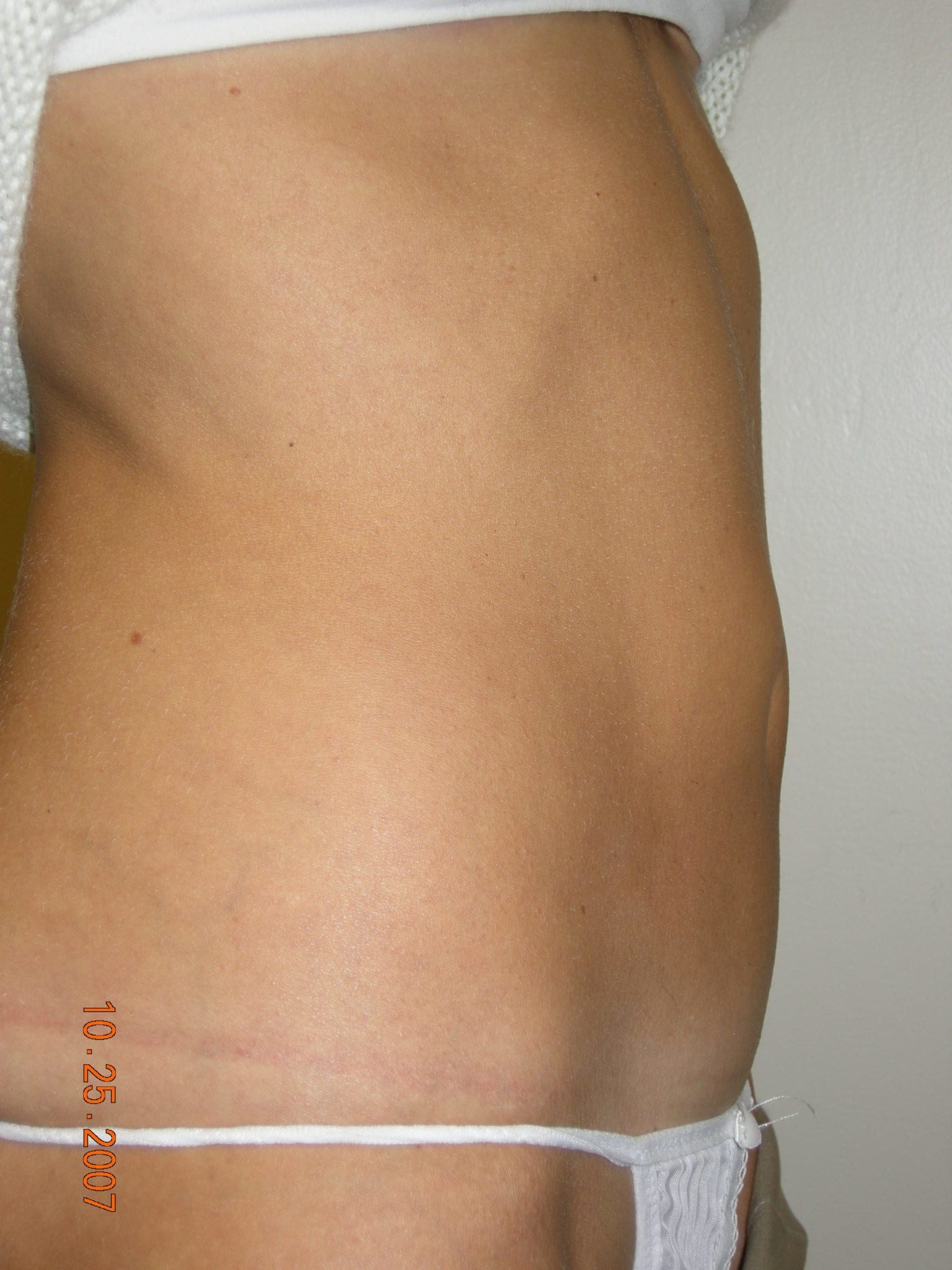 Liposuction Patient Photo - Case 3277 - after view-3