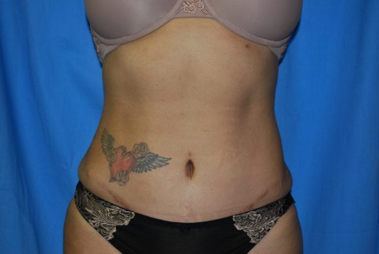 Tummy Tuck - Case 3398 - After