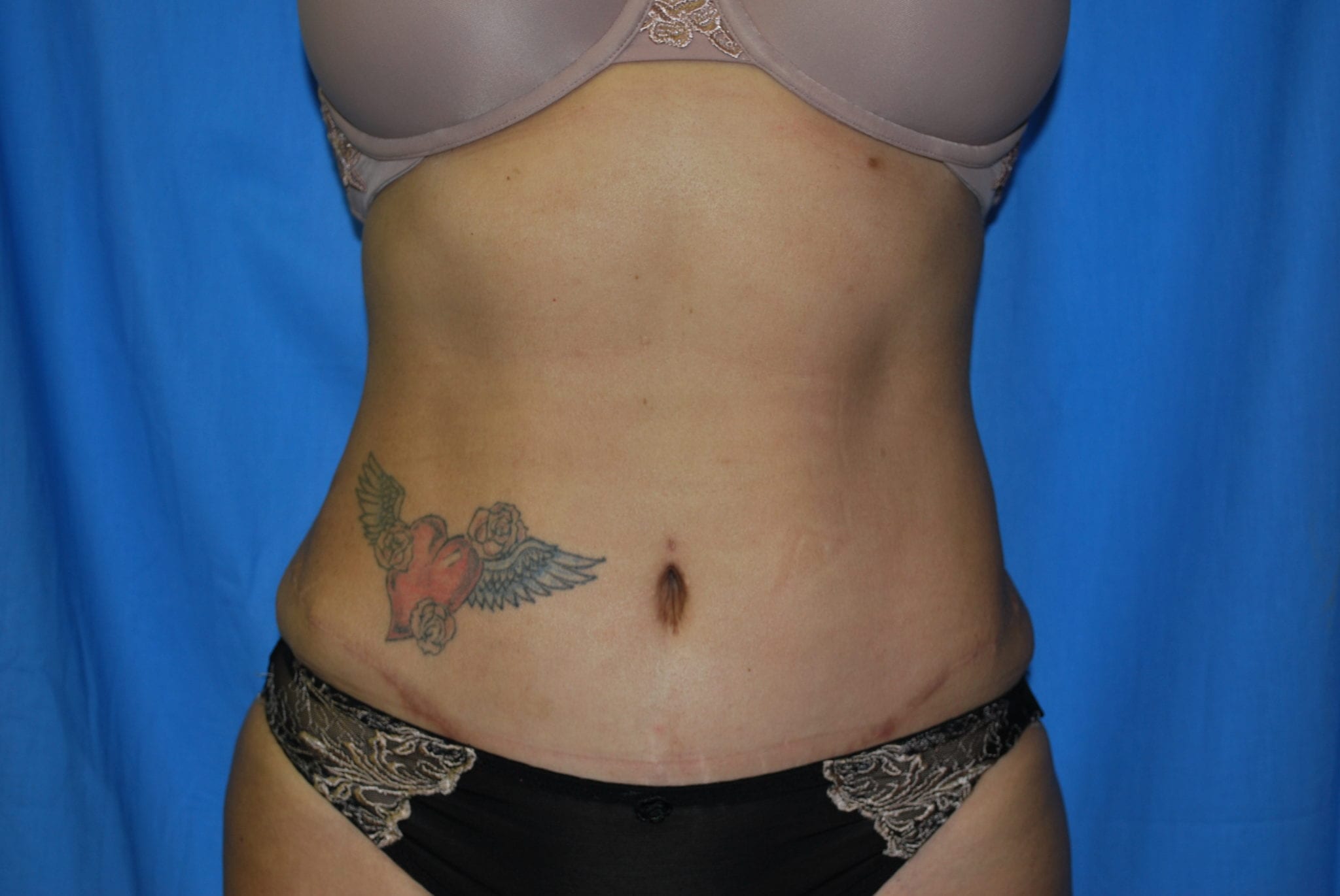Tummy Tuck Patient Photo - Case 3398 - after view-0