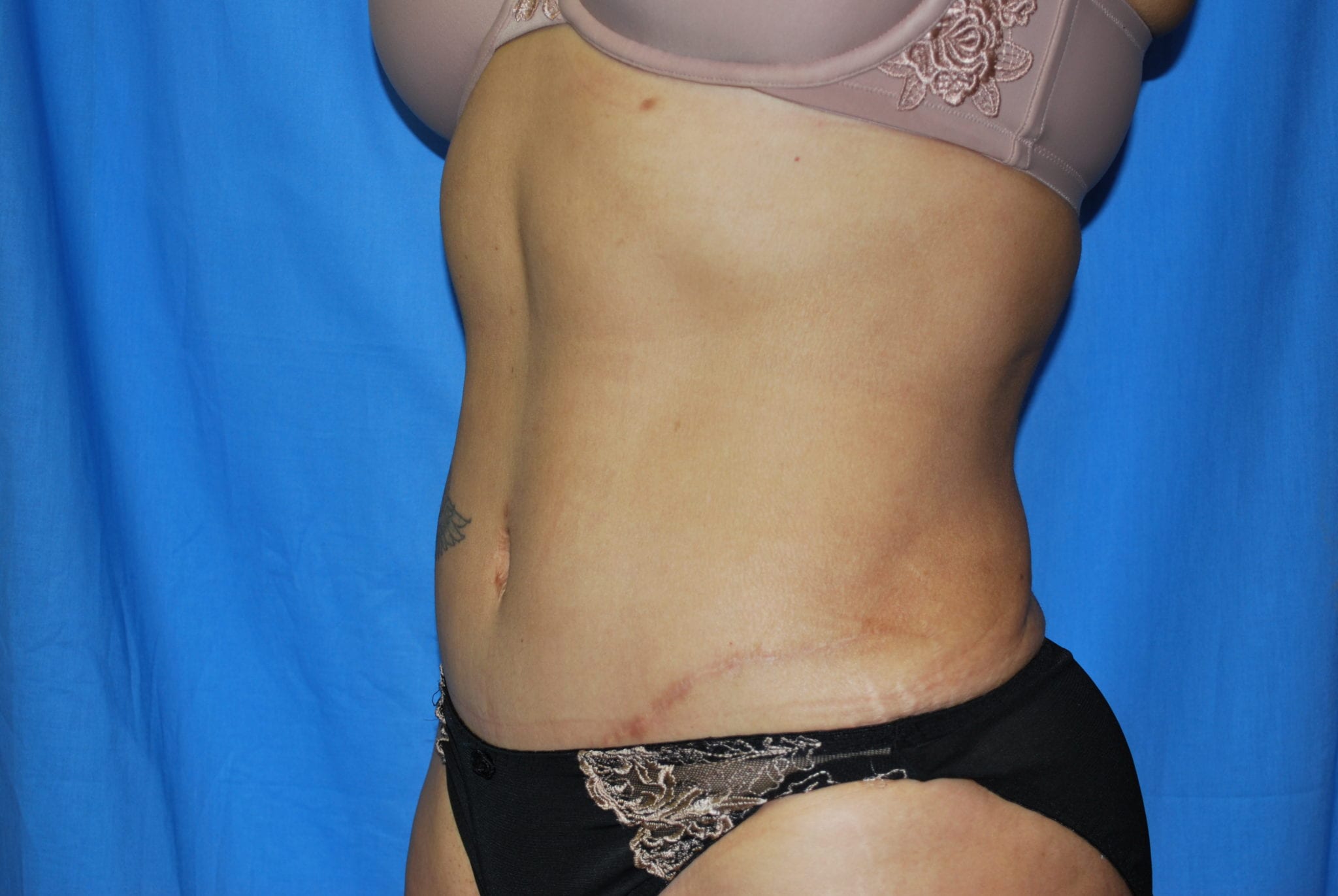 Tummy Tuck Patient Photo - Case 3398 - after view-1
