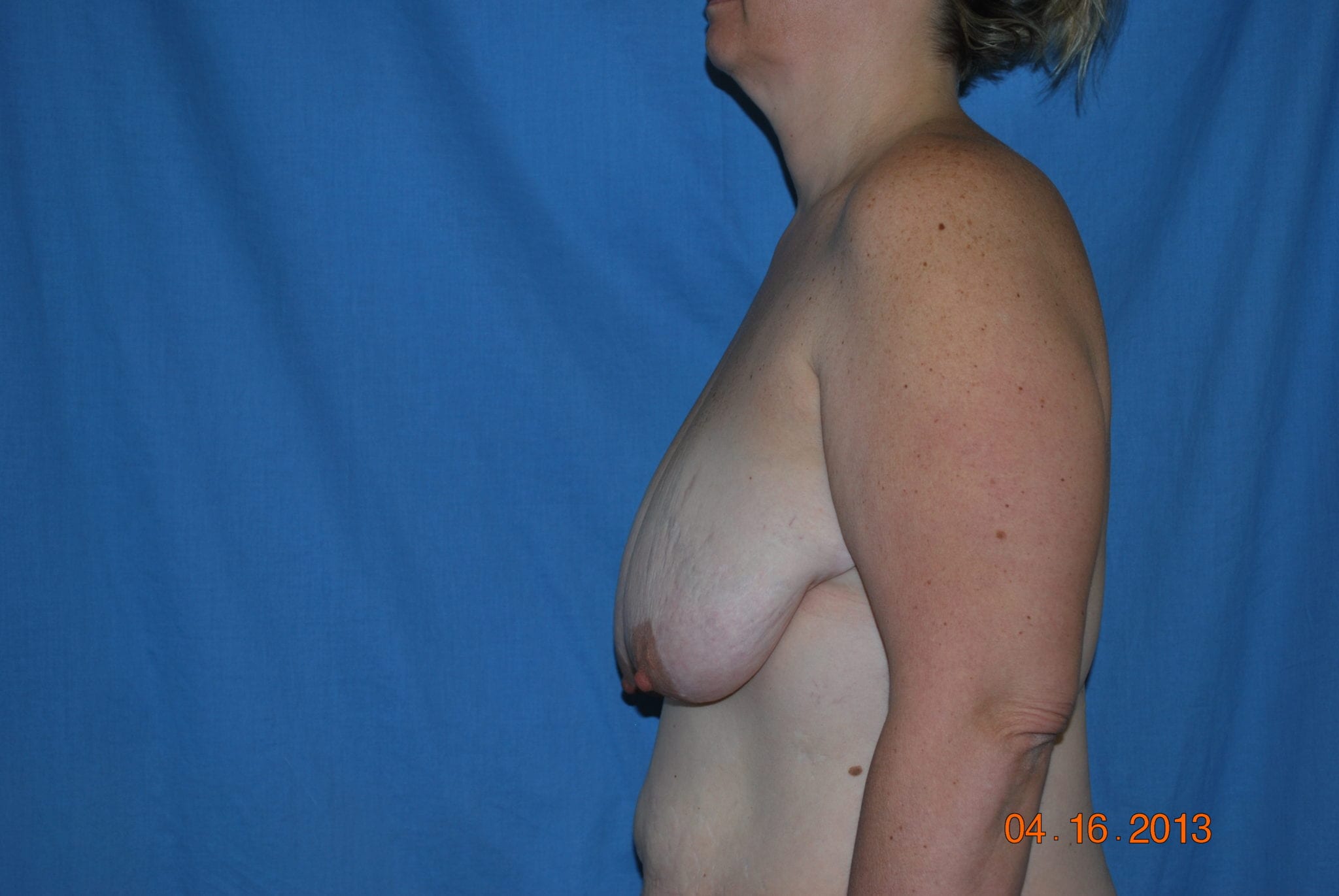 Breast Reduction Patient Photo - Case 4589 - before view-3