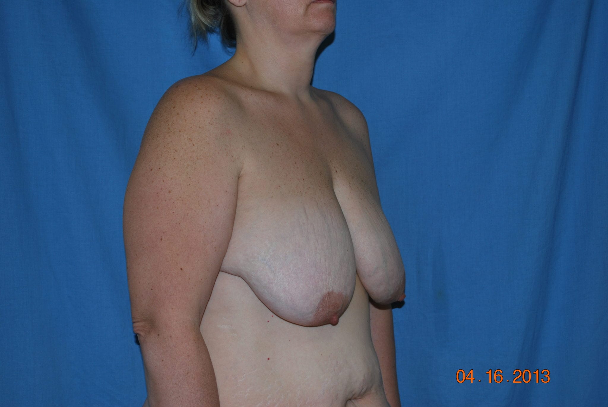 Breast Reduction Patient Photo - Case 4589 - before view-1