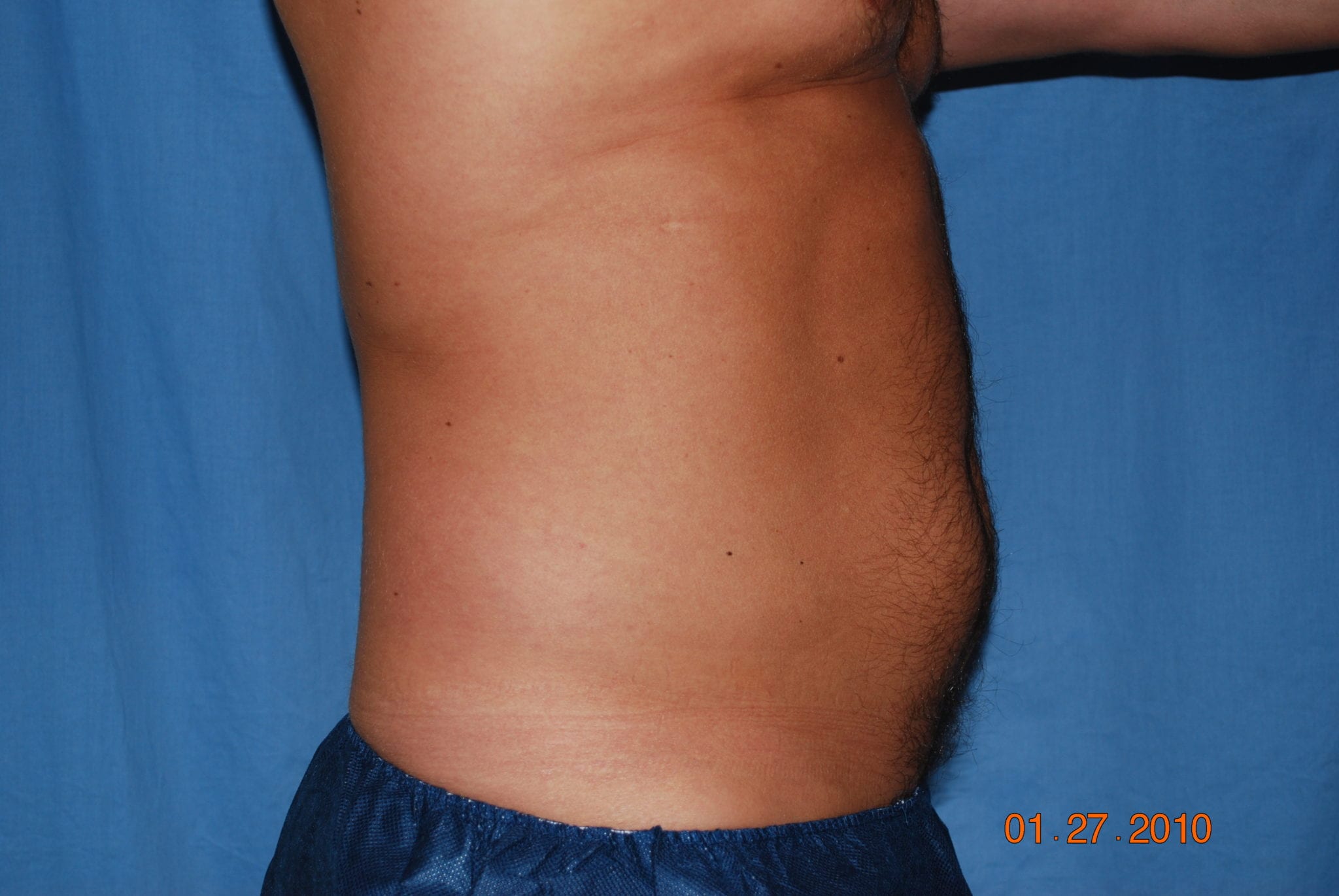 Liposuction Patient Photo - Case 4725 - after view-3