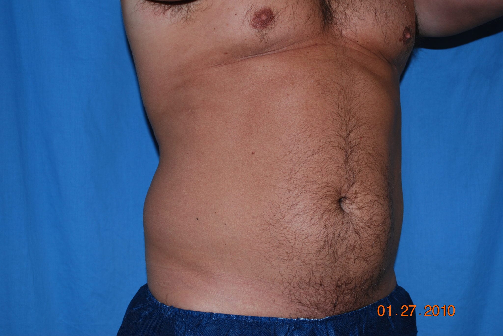 Liposuction Patient Photo - Case 4725 - before view-1