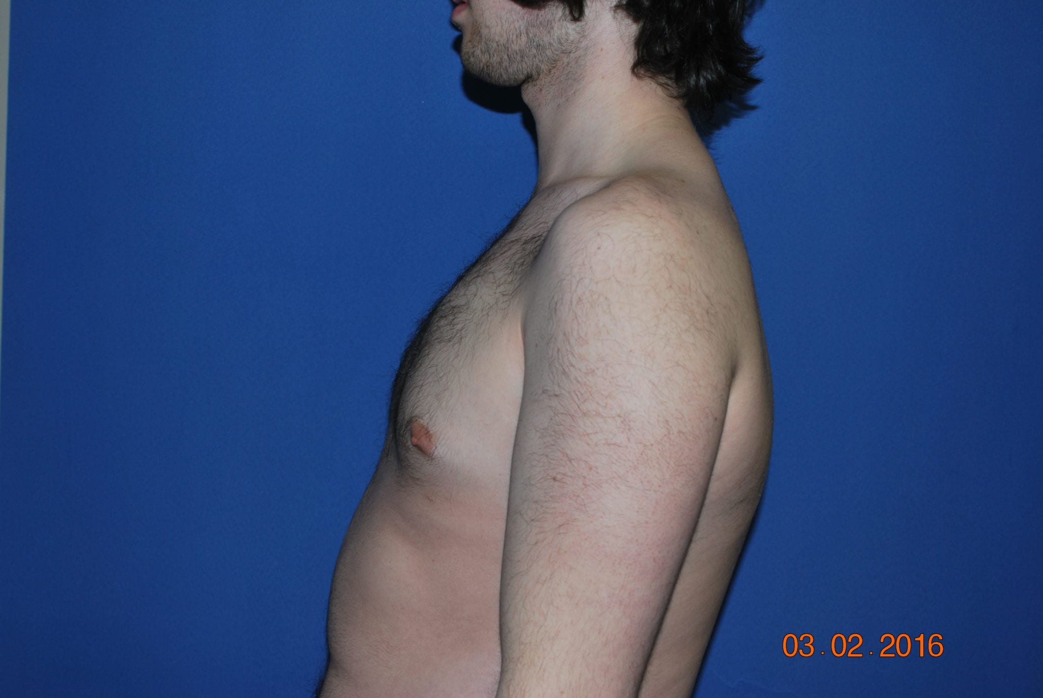 Male Breast Reduction Patient Photo - Case 4897 - after view-4