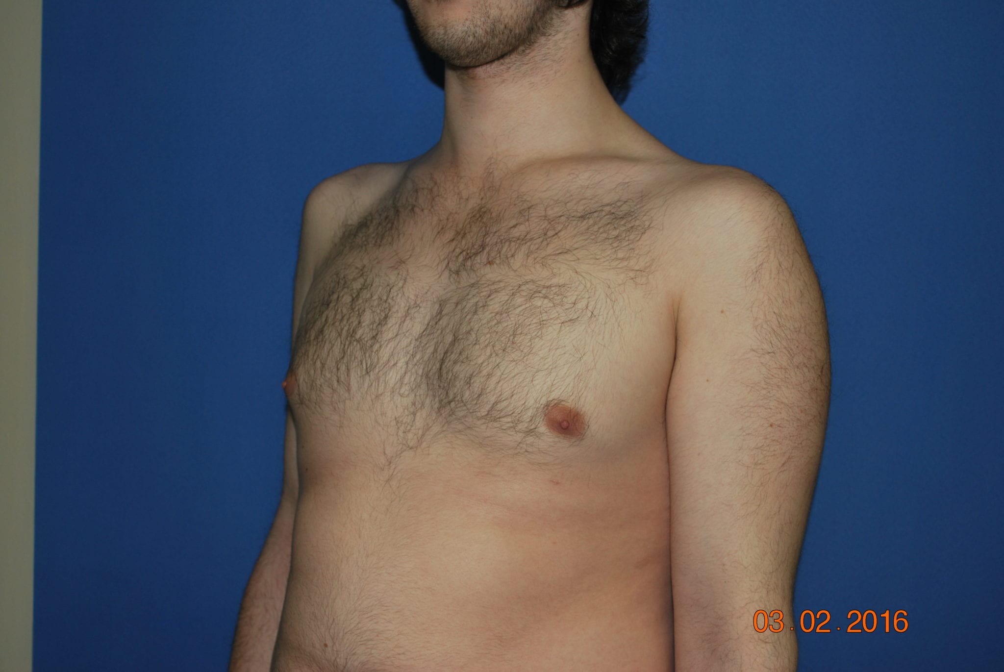 Male Breast Reduction Patient Photo - Case 4897 - after view-3