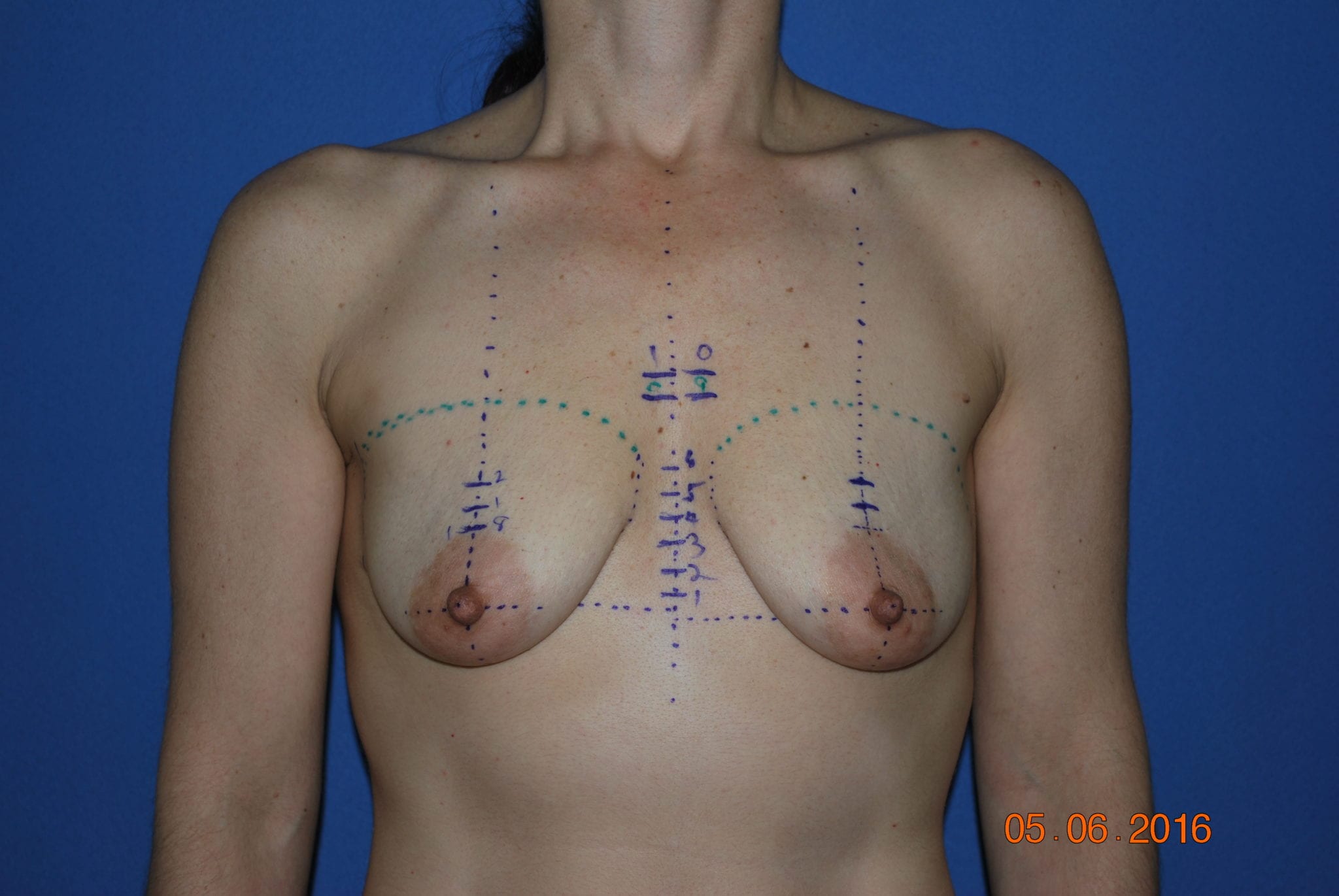 Breast Reduction with Augmentation Patient Photo - Case 2948 - before view-5