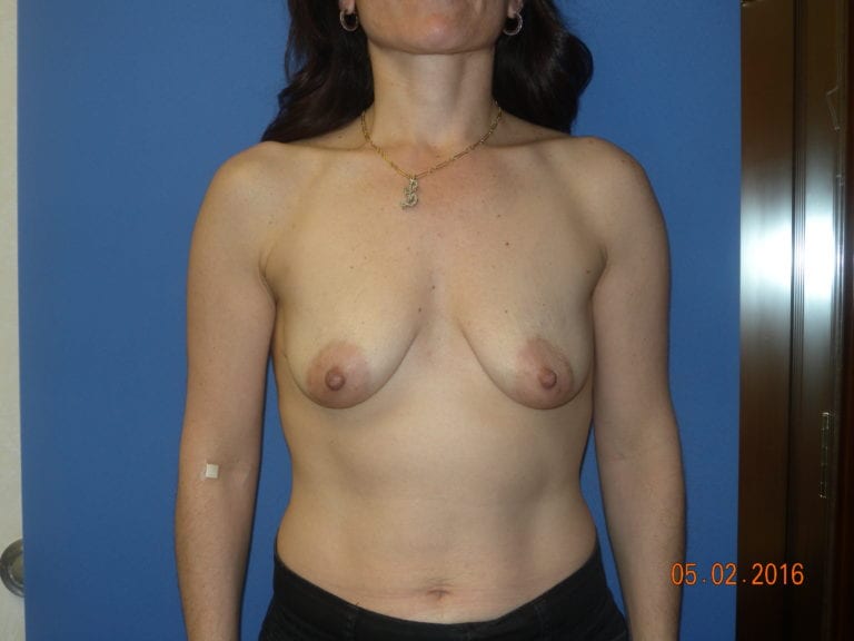 Breast Reduction with Augmentation - Case 2948 - Before