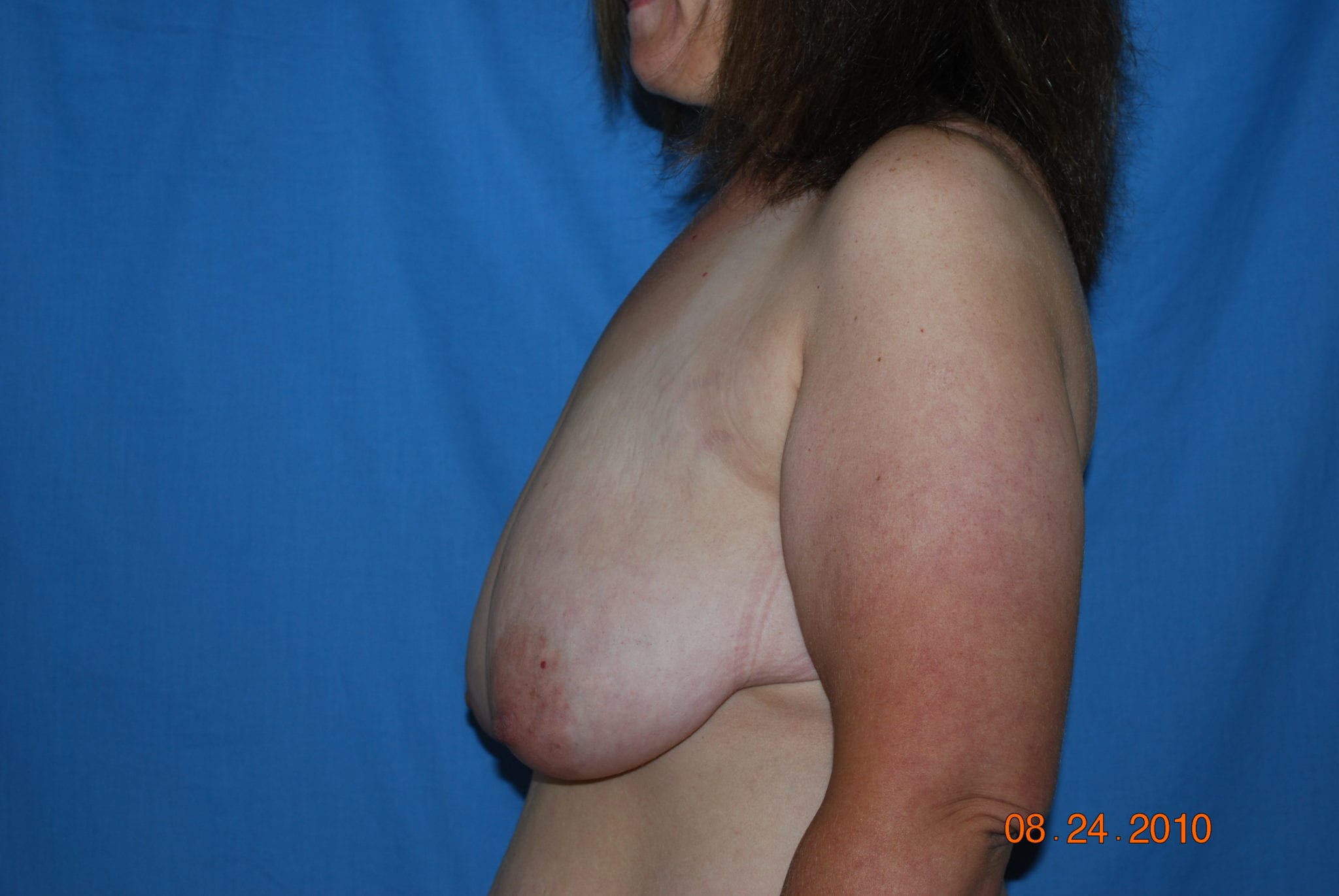 Breast Reduction Patient Photo - Case 4602 - before view-2