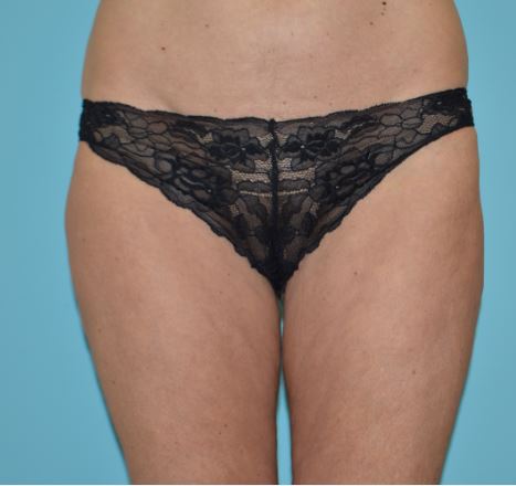 CoolSculpting - Case 471 - Before
