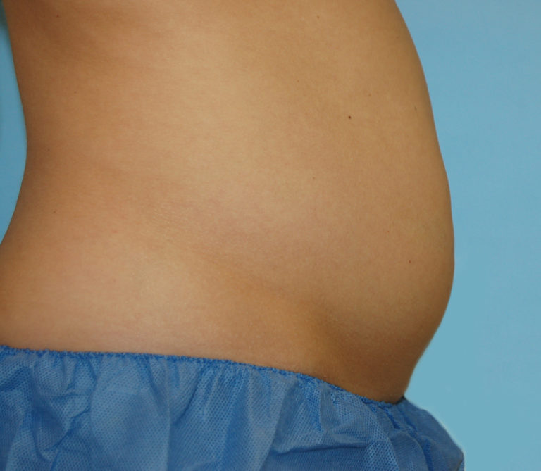 CoolSculpting - Case 474 - Before