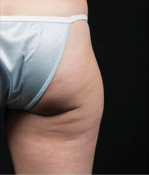 CoolSculpting - Case 468 - Before