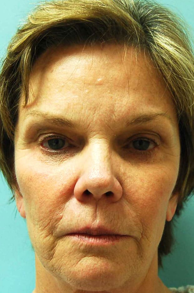 Microlift Patient Photo - Case 3798 - before view-0