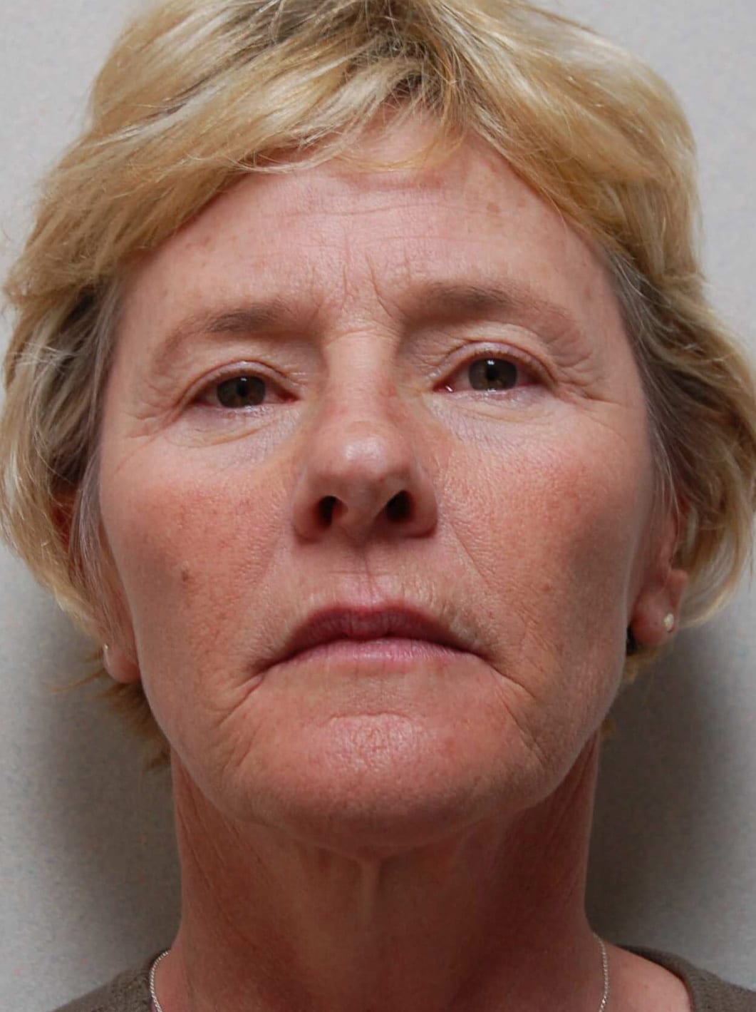 Facial Rejuvenation Patient Photo - Case 3802 - before view-