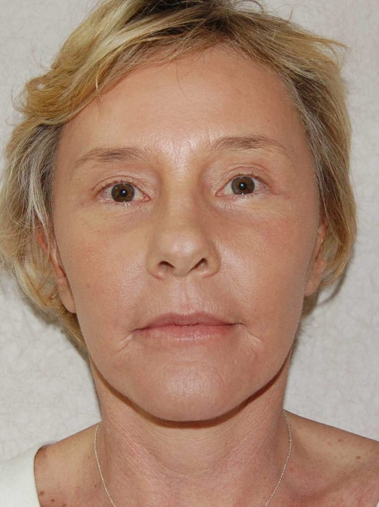 Facial Rejuvenation - Case 3802 - After