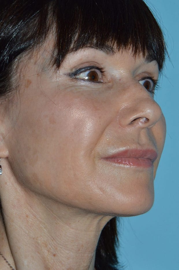 Microlift Patient Photo - Case 3814 - before view-3