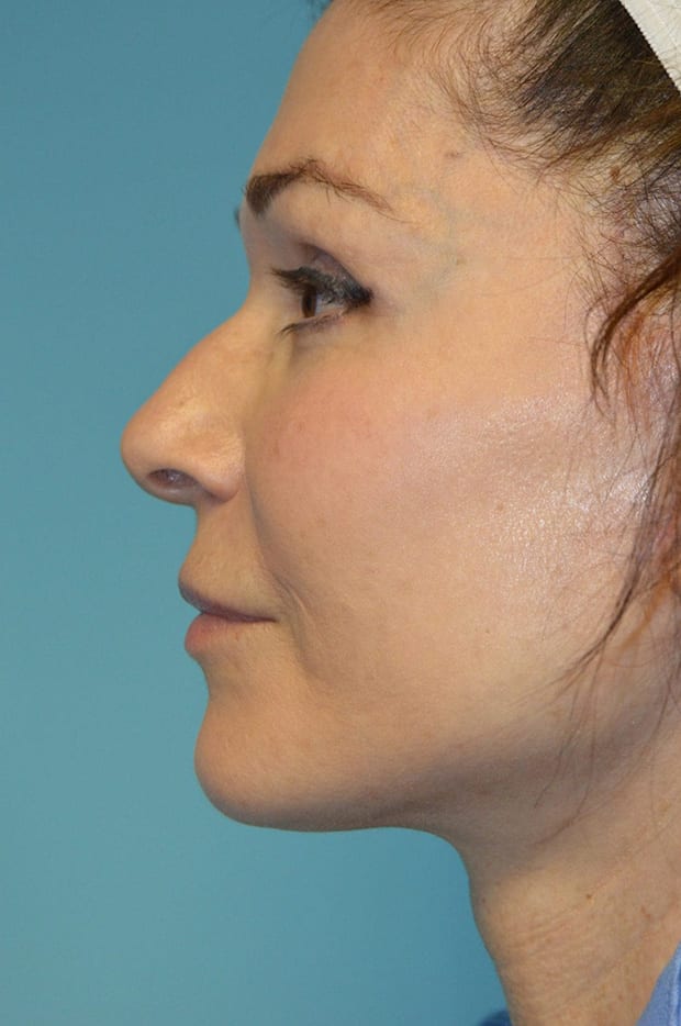 Microlift Patient Photo - Case 3814 - after view-2