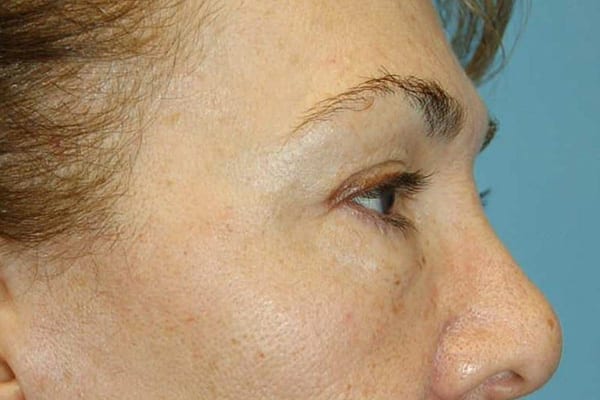 Lower Eyelid Lift/Pinch Patient Photo - Case 3838 - before view-1