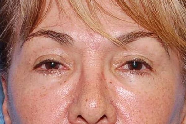 Lower Eyelid Lift/Pinch Patient Photo - Case 3838 - after view-0