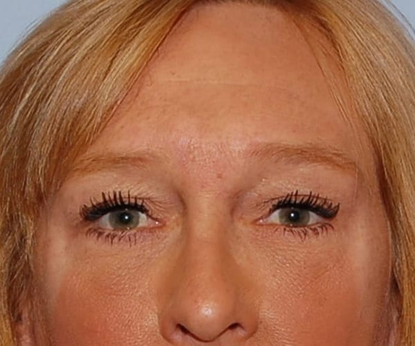 Forehead Lift - Case 3843 - After