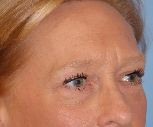 Forehead Lift Patient Photo - Case 3843 - before view-1