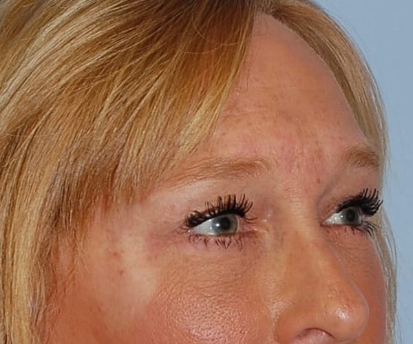 Forehead Lift Patient Photo - Case 3843 - after view-1