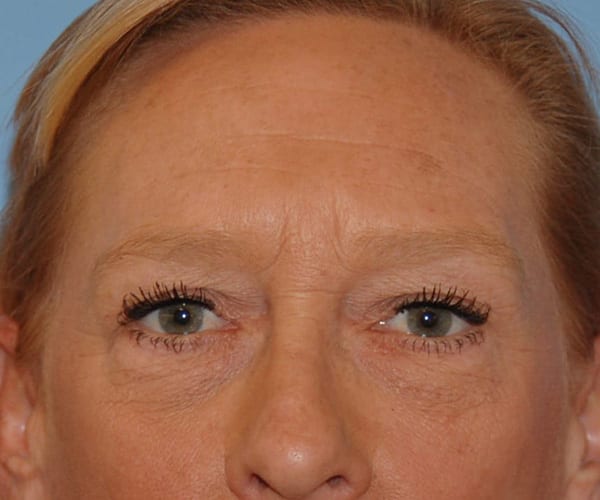 Forehead Lift Patient Photo - Case 3843 - before view-