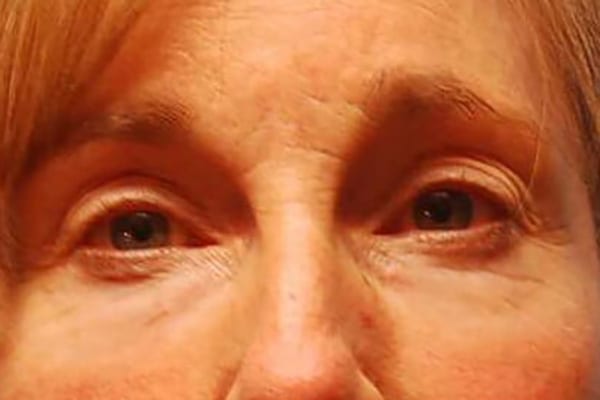 Lower Eyelid Lift/Pinch Patient Photo - Case 3853 - before view-0