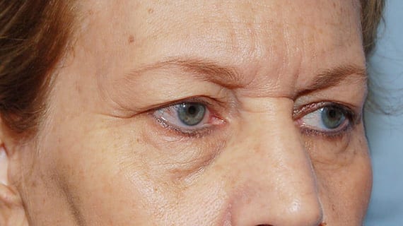 Forehead Lift Patient Photo - Case 3856 - before view-1