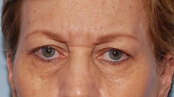 Forehead Lift Patient Photo - Case 3856 - before view-0