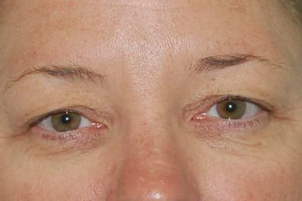 Upper Eyelid Lift Patient Photo - Case 3867 - before view-